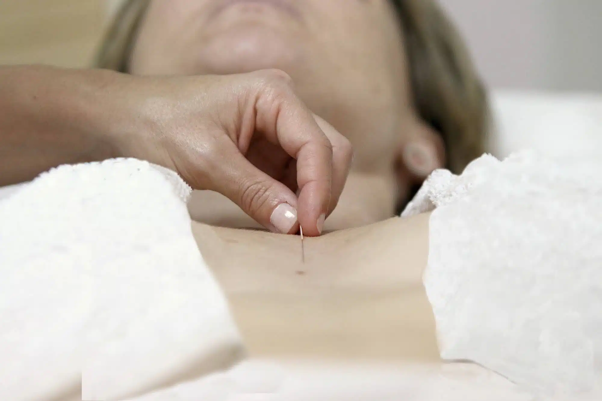 Aplicació d'una sessió d'acupuntura